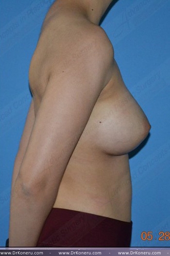 Breast Augmentation Before & After Patient #383