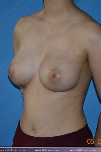 Breast Augmentation Before & After Patient #383