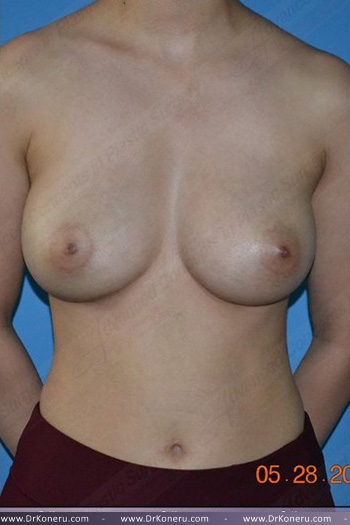 Breast Augmentation Before & After Patient #383