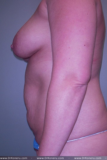 Breast Augmentation Before & After Patient #561