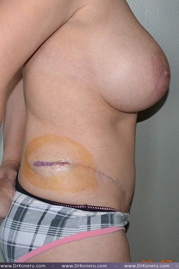 Breast Augmentation Before & After Patient #561