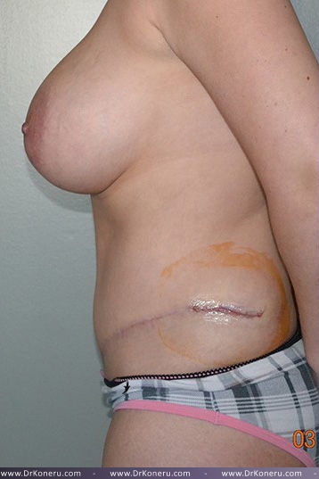 Breast Augmentation Before & After Patient #561