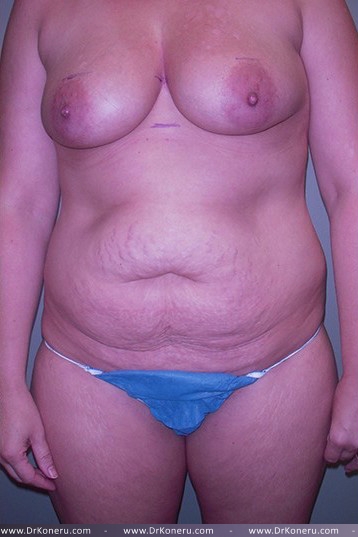 Breast Augmentation Before & After Patient #561