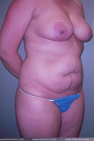 Breast Augmentation Before & After Patient #561