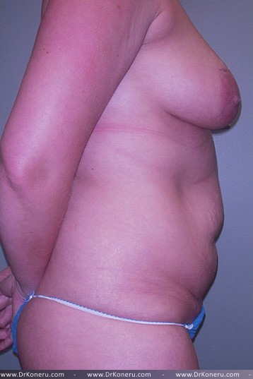 Breast Augmentation Before & After Patient #561