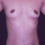 Breast Augmentation Before & After Patient #440