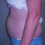 CoolSculpting Before & After Patient #739