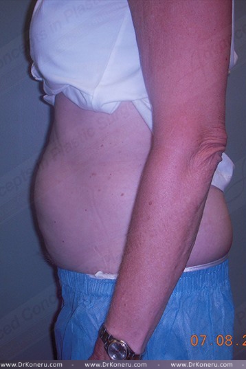 CoolSculpting Before & After Patient #739
