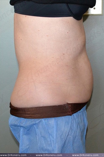 CoolSculpting Before & After Patient #739