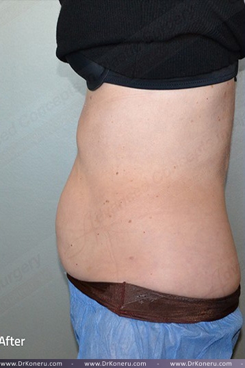CoolSculpting Before & After Patient #739