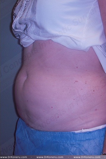 CoolSculpting Before & After Patient #739