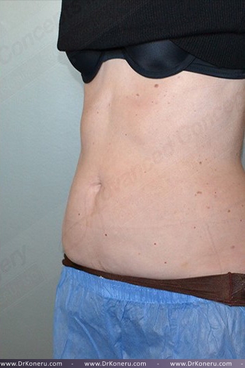 CoolSculpting Before & After Patient #739