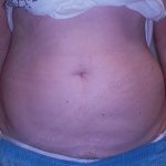 CoolSculpting Before & After Patient #739