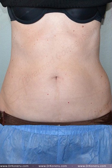 CoolSculpting Before & After Patient #739