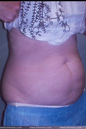 CoolSculpting Before & After Patient #739