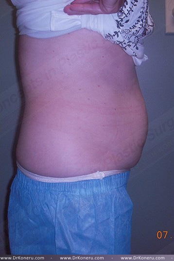 CoolSculpting Before & After Patient #739