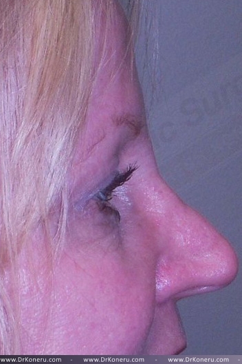 Blepharoplasty Before & After Patient #361