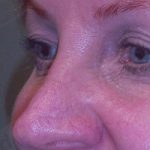 Blepharoplasty Before & After Patient #361