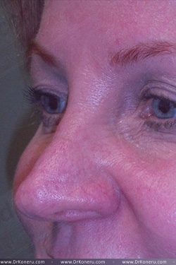 Blepharoplasty Before & After Patient #361