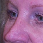 Blepharoplasty Before & After Patient #361