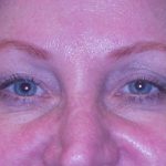 Blepharoplasty Before & After Patient #361