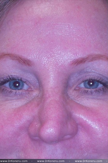 Blepharoplasty Before & After Patient #361