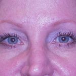 Blepharoplasty Before & After Patient #361