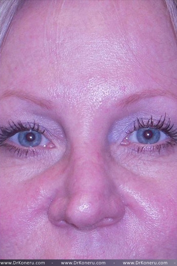 Blepharoplasty Before & After Patient #361