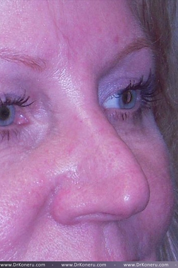 Blepharoplasty Before & After Patient #361