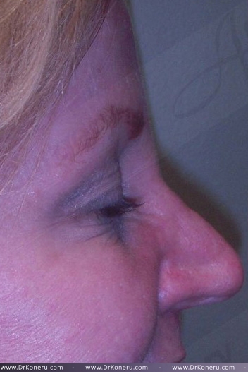 Blepharoplasty Before & After Patient #361