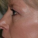 Blepharoplasty Before & After Patient #372