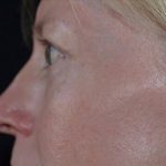 Blepharoplasty Before & After Patient #372