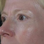Blepharoplasty Before & After Patient #372