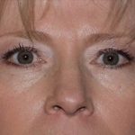 Blepharoplasty Before & After Patient #372