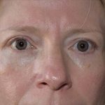 Blepharoplasty Before & After Patient #372