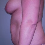 Mommy Makeover Before & After Patient #639