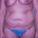 Mommy Makeover Before & After Patient #639