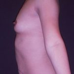 Mommy Makeover Before & After Patient #650