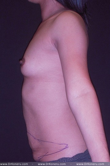 Mommy Makeover Before & After Patient #650