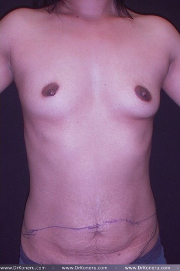 Mommy Makeover Before & After Patient #650
