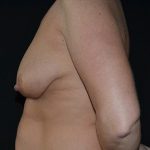 Mommy Makeover Before & After Patient #672