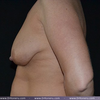 Mommy Makeover Before & After Patient #672