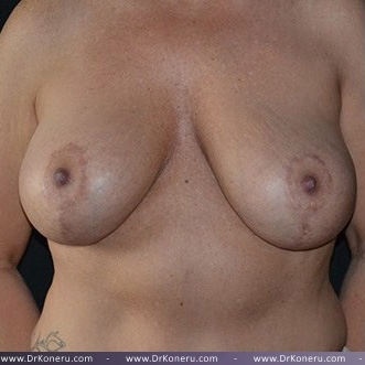 Mommy Makeover Before & After Patient #672