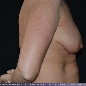 Mommy Makeover Before & After Patient #672
