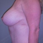 Mommy Makeover Before & After Patient #683