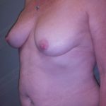 Mommy Makeover Before & After Patient #683