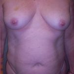 Mommy Makeover Before & After Patient #683