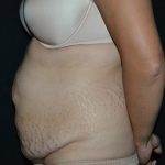 Tummy Tuck Before & After Patient #583