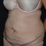 Tummy Tuck Before & After Patient #583