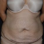 Tummy Tuck Before & After Patient #583